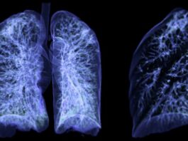 AI Tool Matches Doctors in Lung Tumor Mapping