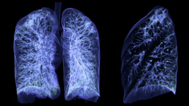 AI Tool Matches Doctors in Lung Tumor Mapping