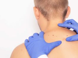 Groundbreaking AI tool could diagnose skin cancer early in remote areas