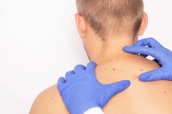 07124223-242cd92d-38eb-46c5-97bb-e62ede0a6e9a.jpg Groundbreaking AI tool could diagnose skin cancer early in remote areas