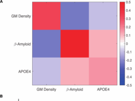 AI-guided patient stratification improves outcomes and efficiency in the AMARANTH Alzheimer’s Disease clinical trial