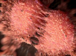 AI tool can detect prostate cancer missed by pathologists