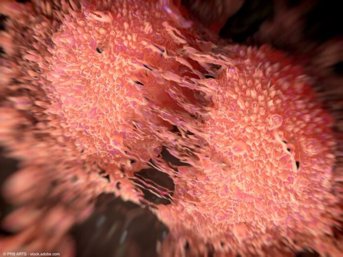 AI tool can detect prostate cancer missed by pathologists
