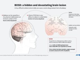 AI Tool Helps Researchers Treat Child Epilepsy