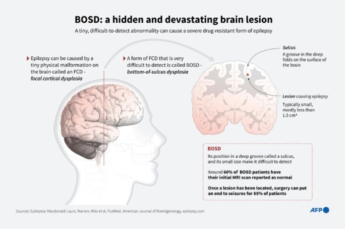 AI Tool Helps Researchers Treat Child Epilepsy