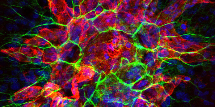 1200x600Choroidal-neovascularization.jpg How AI is transforming retinal imaging
