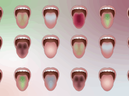 AI Scans Tongue Color to Predict Diseases
