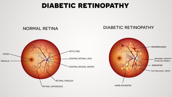 Know About First AI Retinopathy Screening Programme