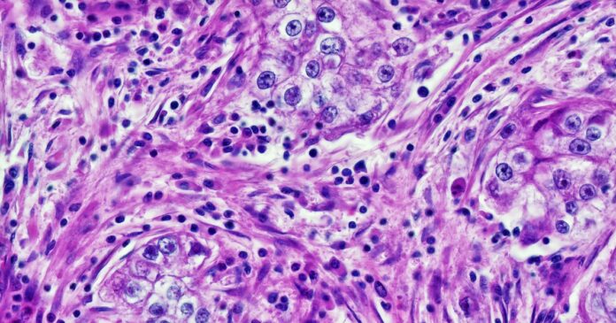 Doctors Catch Cancer-Diagnosing AI Extracting Patients' Race Data and Being Racist With It