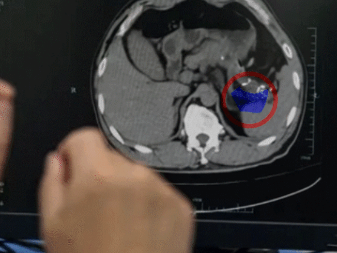 In China, AI finds deadly tumors that doctors might miss; Tool detects deadliest 'Asymptomatic pancreatic cancer'; disease that killed Steve Jobs