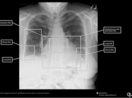FDA Approves Qure.ai’s Chest X-Ray Reporting Tool for Six New Indications FDA Clears Six Indications for Qure.ai's Chest X-Ray Reporting Tool