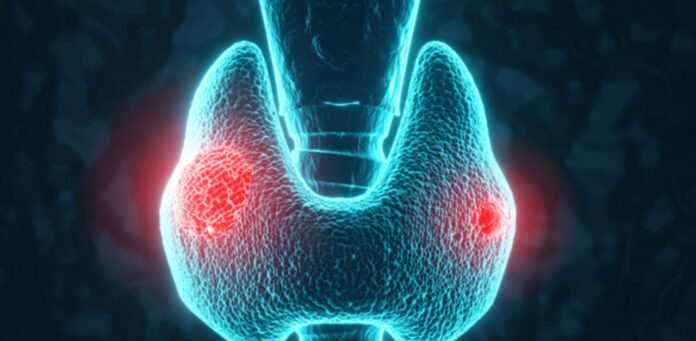 AI Tools Expand in Thyroid Cancer Diagnosis