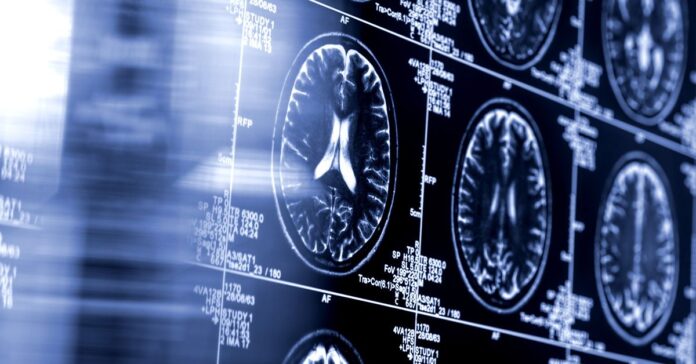 AI-driven stroke tool shows improved outcomes in major clinical trial