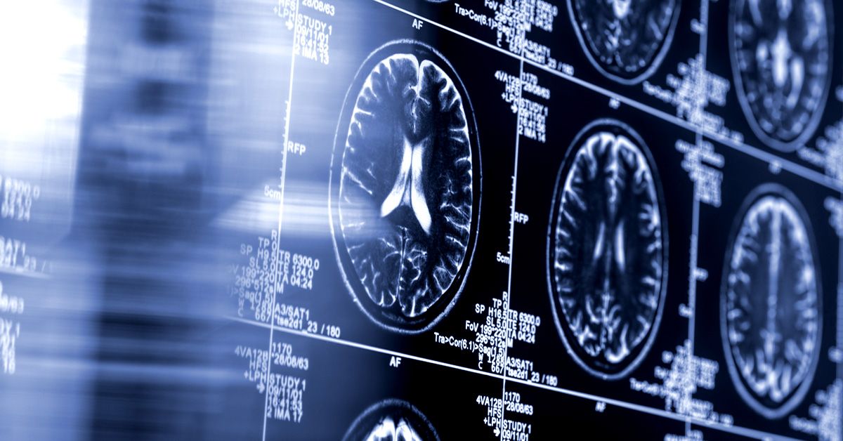 brain-scans-1200-628-facebook.jpg AI-driven stroke tool shows improved outcomes in major clinical trial